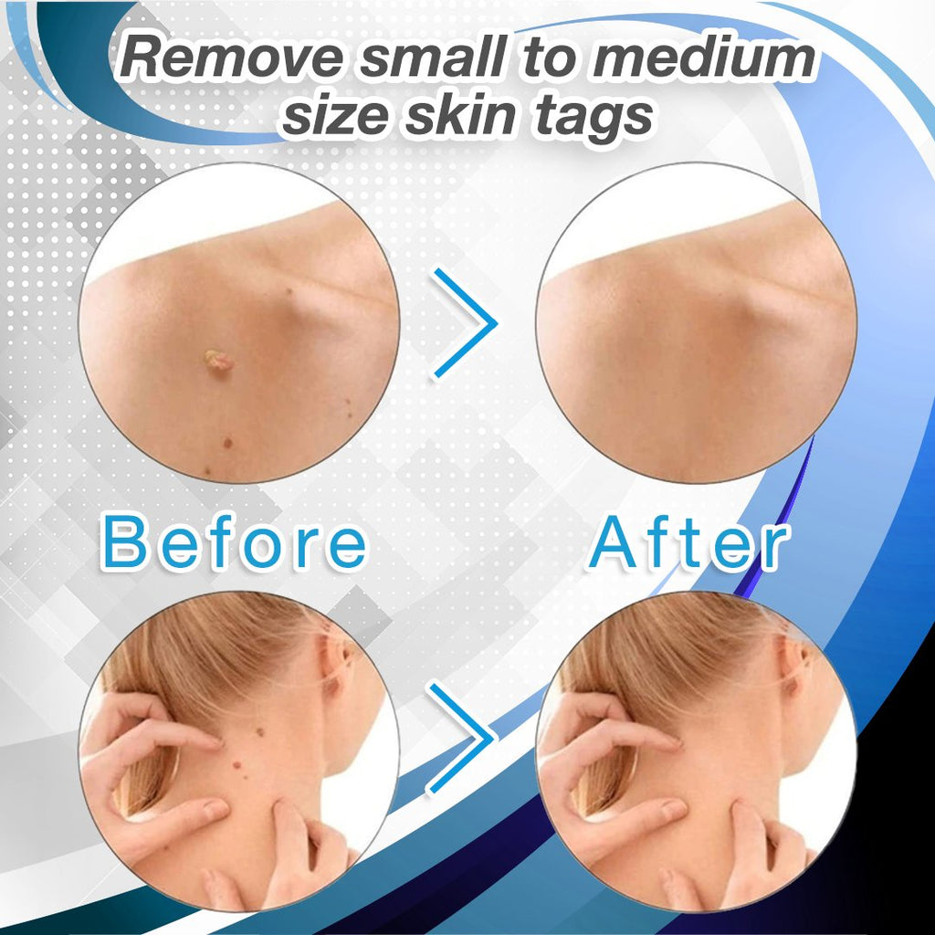 SkinRx Microband Skin Tag Removal Kit