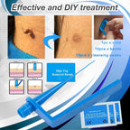 SkinRx Microband Skin Tag Removal Kit