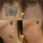 Permanent Tattoo Removal Cream