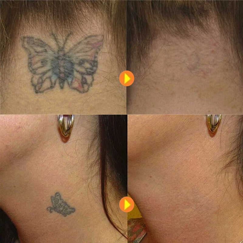 Permanent Tattoo Removal Cream